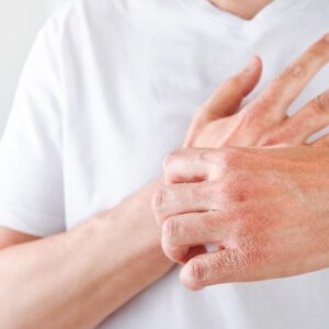 7 Natural Remedies for Eczema to Try