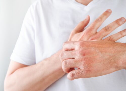 7 Natural Remedies for Eczema to Try