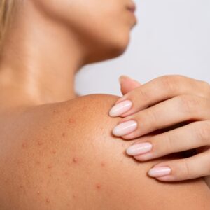 What Causes Bacne and How Do You Get Rid of It?