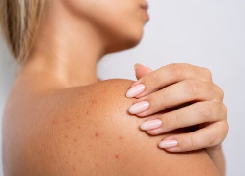 What Causes Bacne and How Do You Get Rid of It?