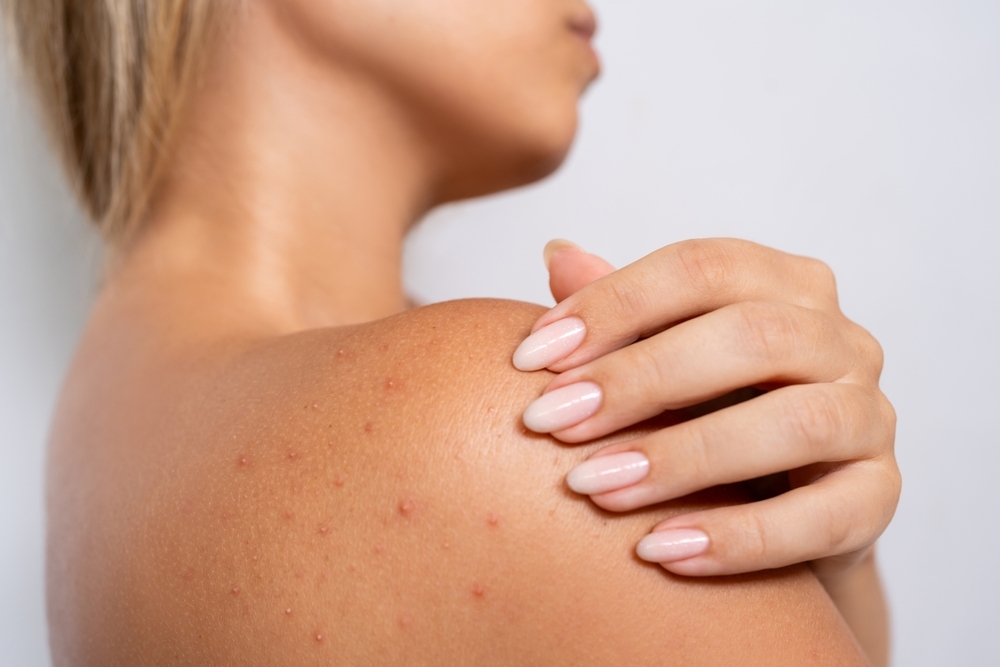 What Causes Bacne and How Do You Get Rid of It?