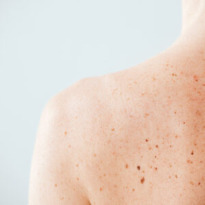 Why Do Some Melanomas Appear in Areas Never Exposed to Sun?