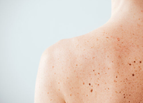 Why Do Some Melanomas Appear in Areas Never Exposed to Sun?
