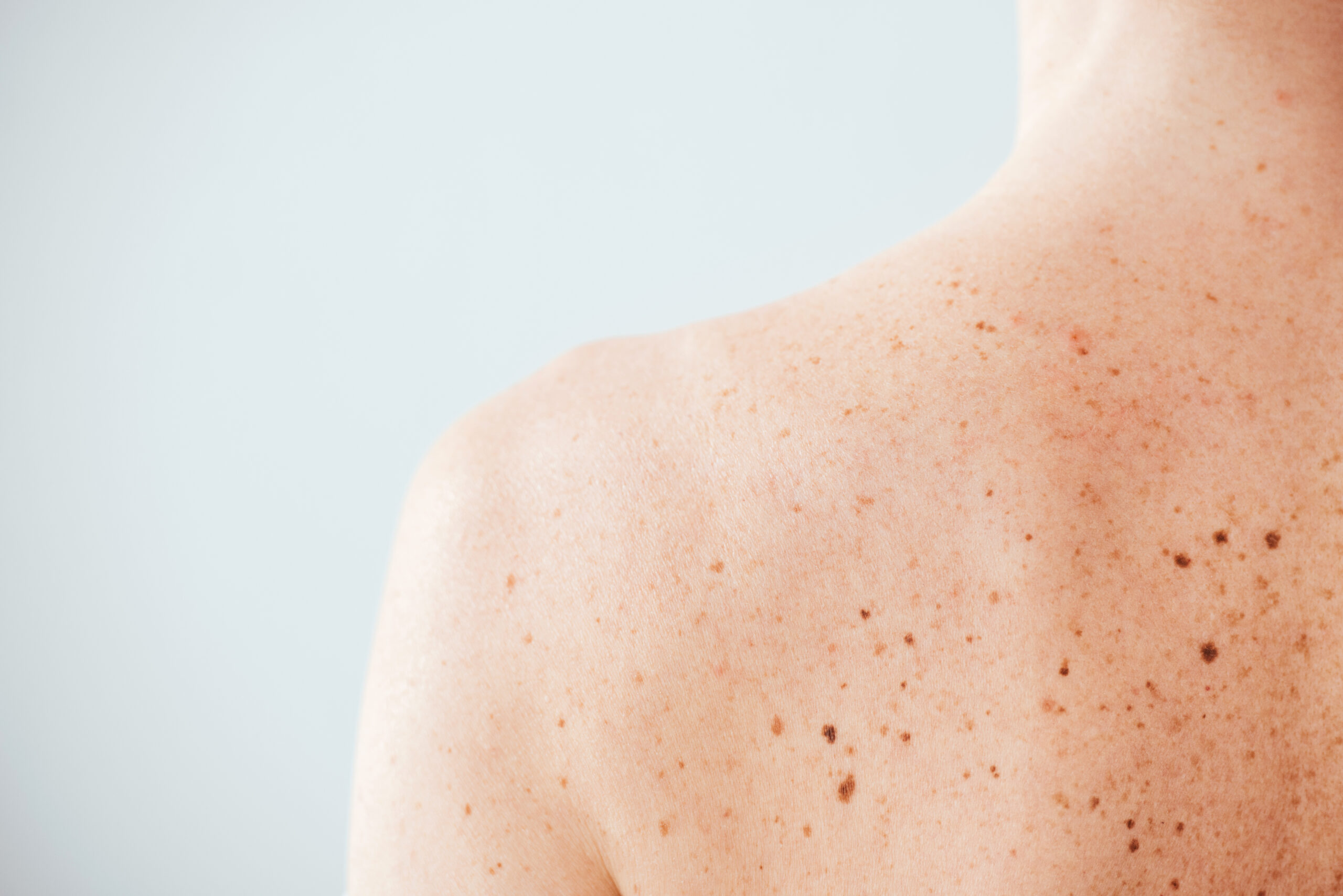 Why Do Some Melanomas Appear in Areas Never Exposed to Sun?