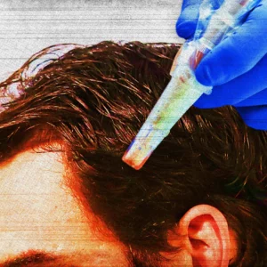 Dr. Kilgour Featured in the GQ’s “What Is Microneedling and Does It Really Prevent Hair Loss?”