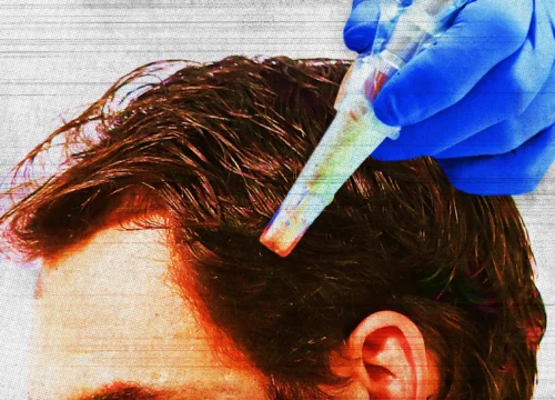 Dr. Kilgour Featured in the GQ’s “What Is Microneedling and Does It Really Prevent Hair Loss?”