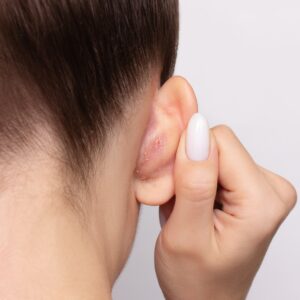 Top 4 Body Areas Where Seborrheic Dermatitis Commonly Appears