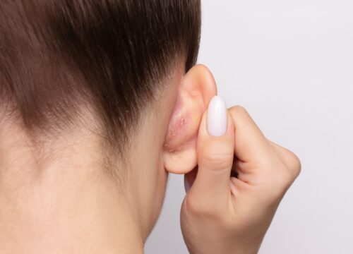 Top 4 Body Areas Where Seborrheic Dermatitis Commonly Appears