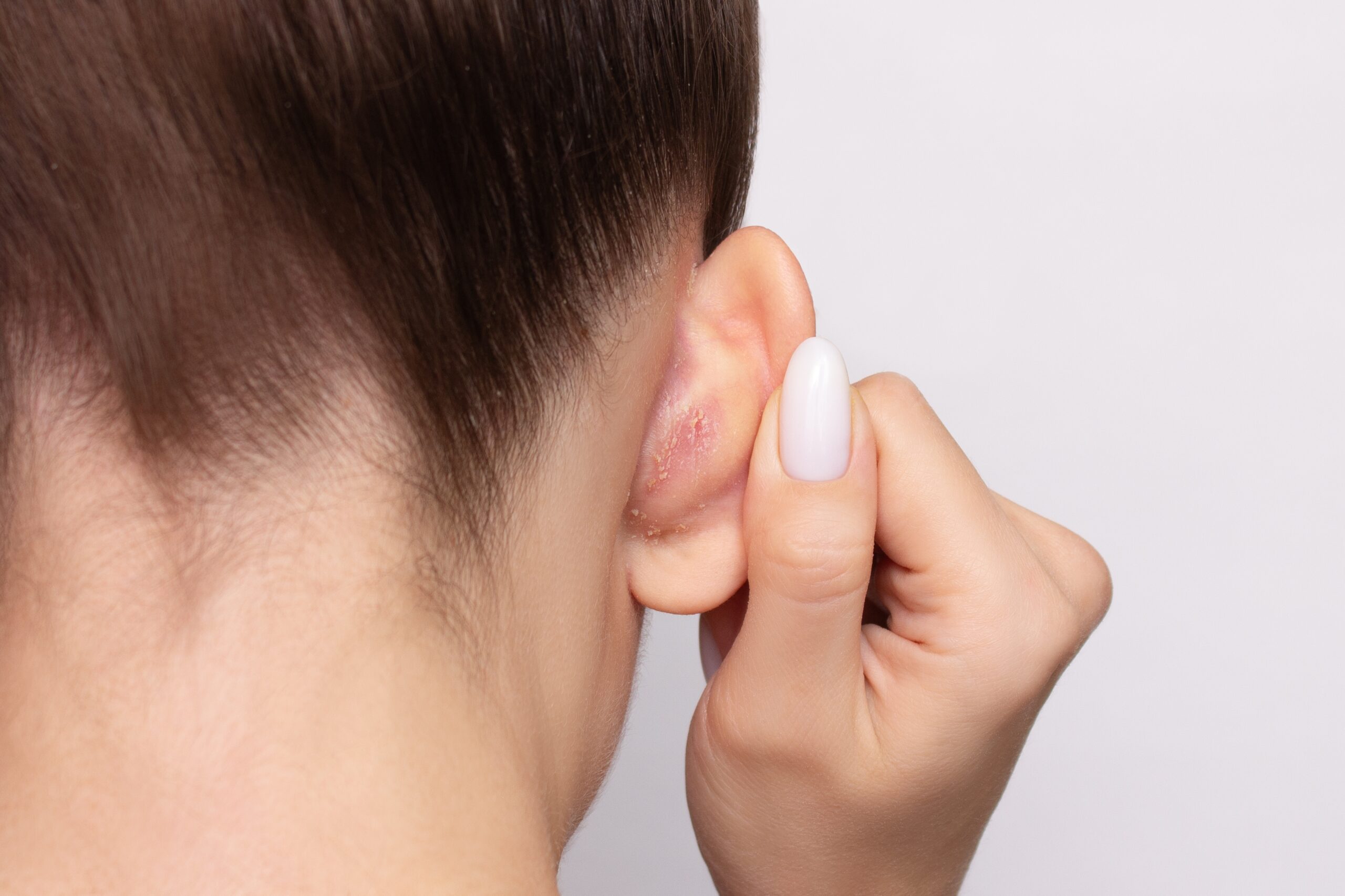 Top 4 Body Areas Where Seborrheic Dermatitis Commonly Appears