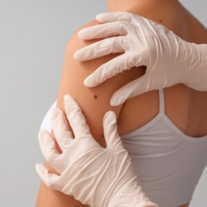 Is Melanoma Rough to the Touch?