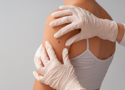 Is Melanoma Rough to the Touch?