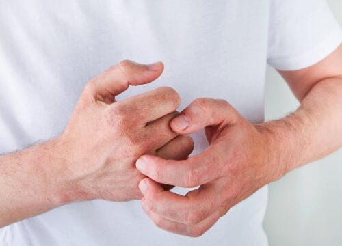 How Do You Know if You Need Systemic Medications for Psoriasis?