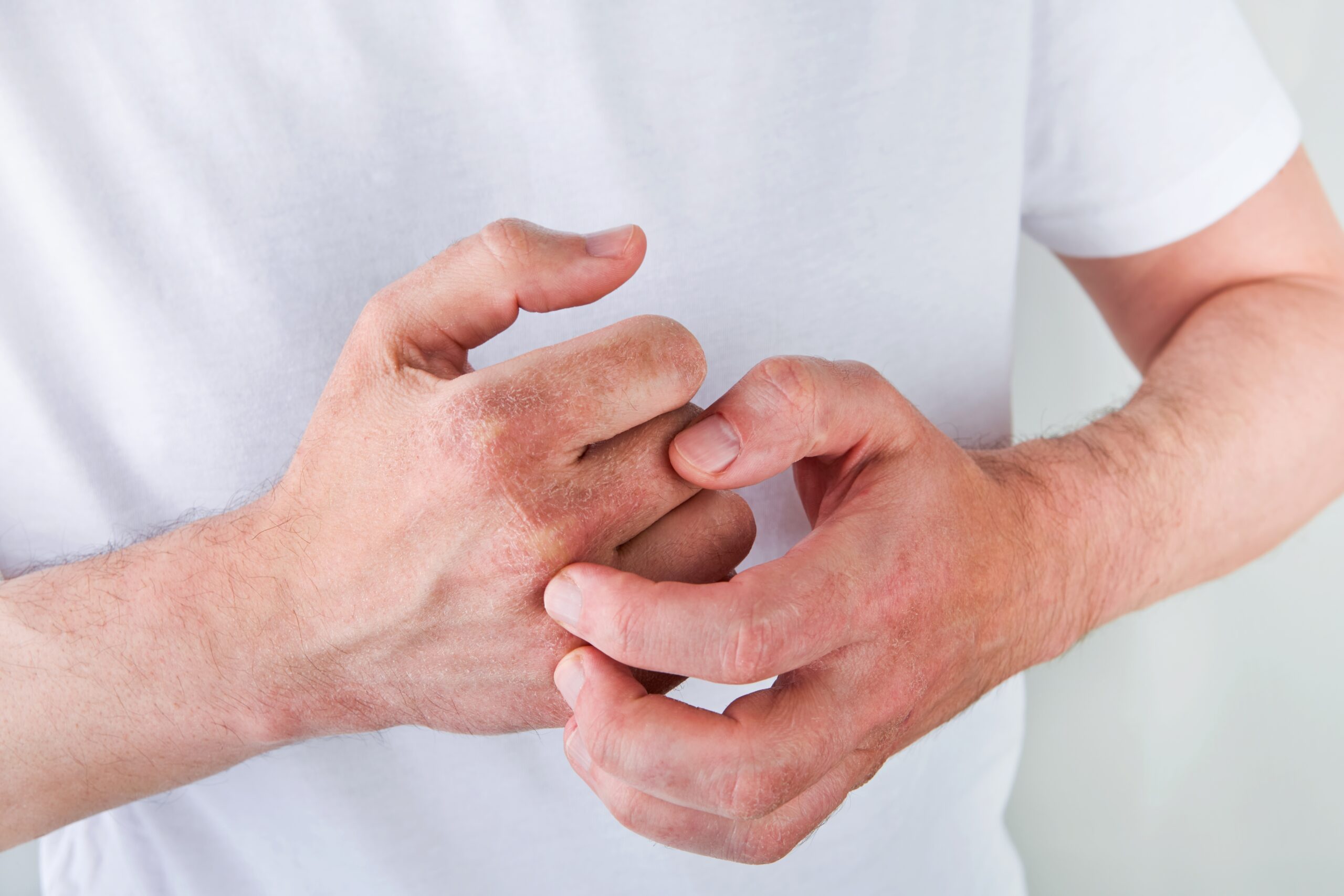 How Do You Know if You Need Systemic Medications for Psoriasis?