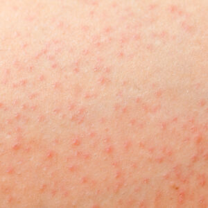 How Can You Tell If Your Razor Bumps Are Actually Bacterial Folliculitis