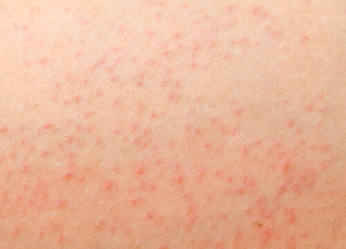 How Can You Tell If Your Razor Bumps Are Actually Bacterial Folliculitis