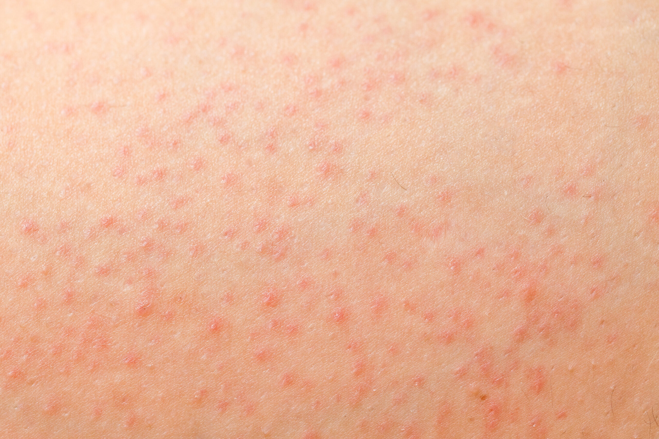 How Can You Tell If Your Razor Bumps Are Actually Bacterial Folliculitis