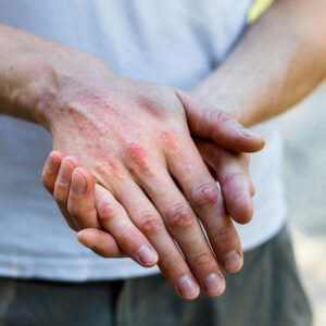 5 Reasons Your Eczema Treatment Isn’t Working and What to Try Instead