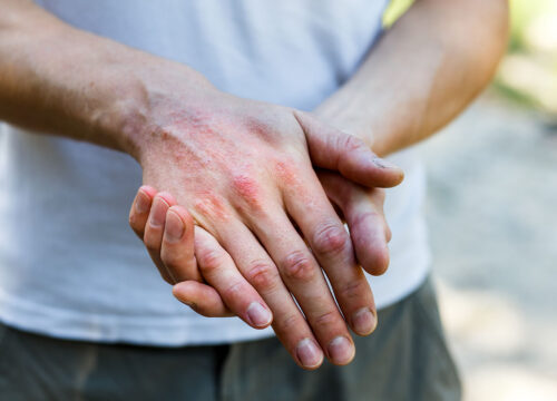 5 Reasons Your Eczema Treatment Isn’t Working and What to Try Instead