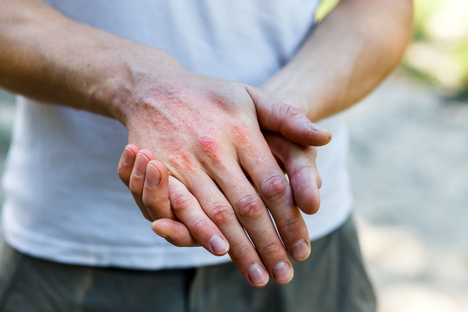5 Reasons Your Eczema Treatment Isn’t Working and What to Try Instead