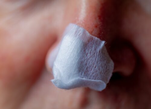 Can You Speed Up Healing After Mohs?